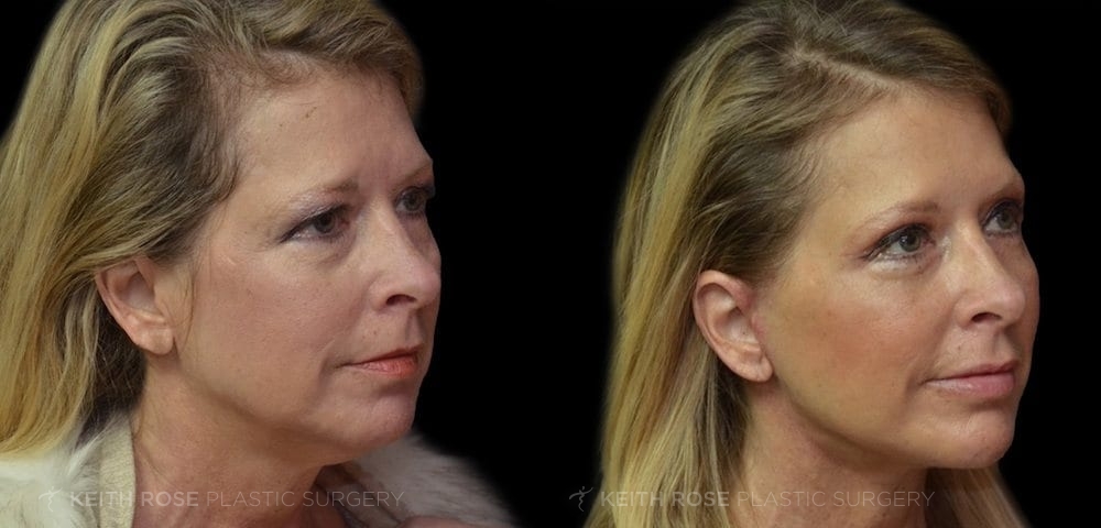 0001_rose_facelift_corpuschristi_patient02b