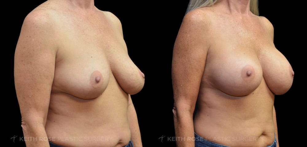 0002_rose_breastaugmentation_corpuschristi_patient34a