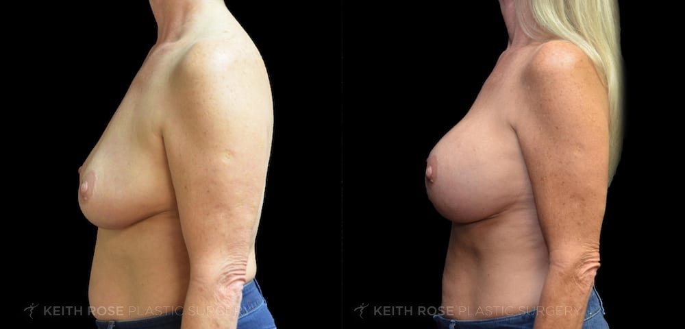 0004_rose_breastaugmentation_corpuschristi_patient34c