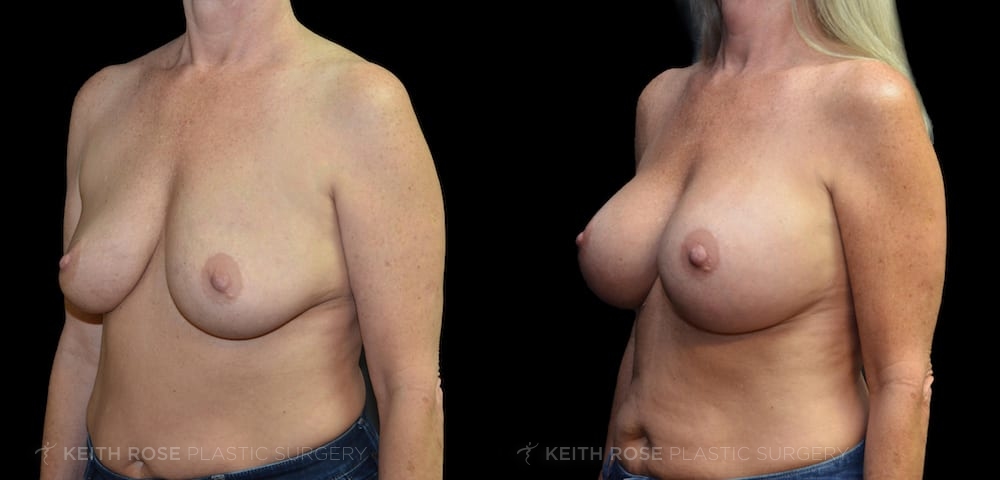 0005_rose_breastaugmentation_corpuschristi_patient34d
