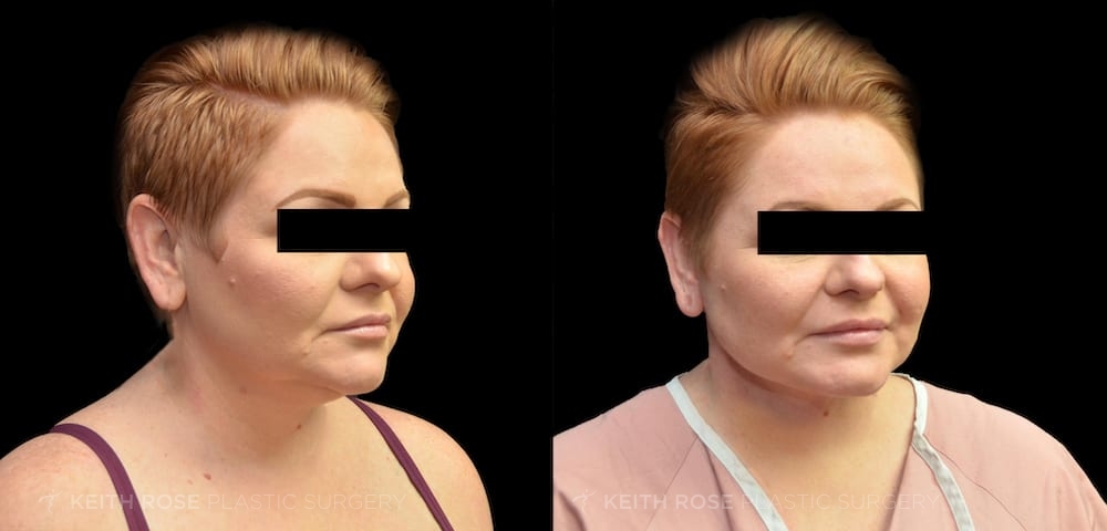 0005_rose_faceliftnecklift_corpuschristi_patient6b