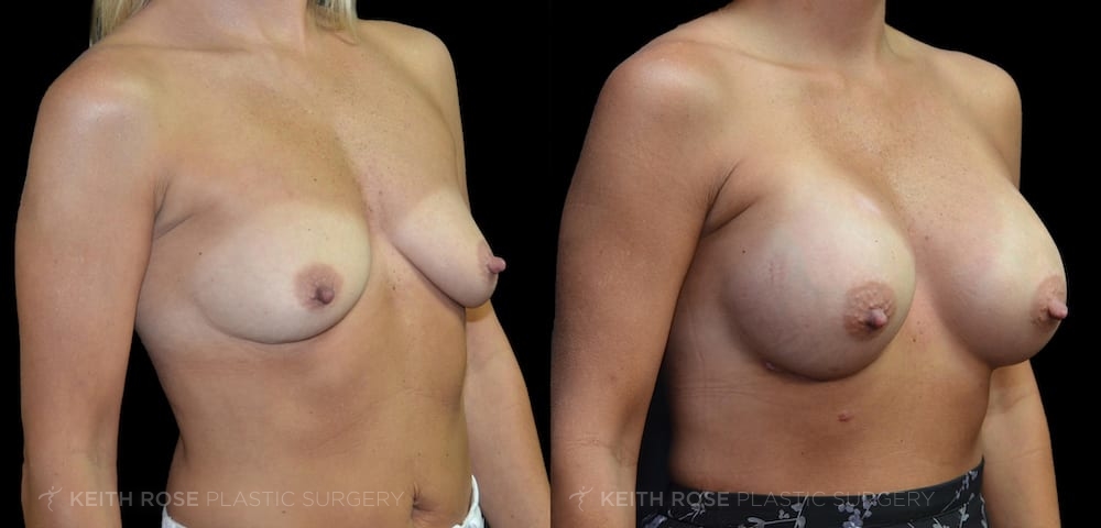 0006_rose_breastaugmentation_corpuschristi_patient36a