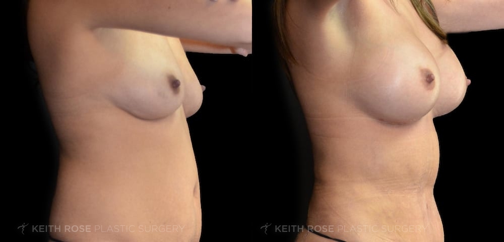 0006_rose_breastaugmentation_corpuschristi_patient60a