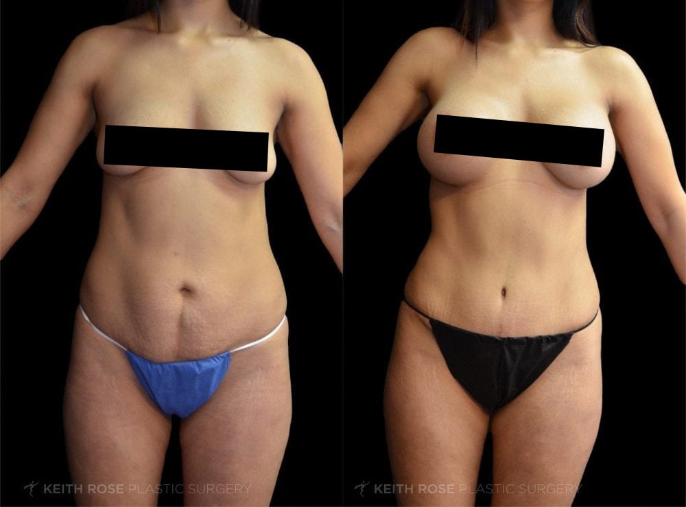 Mommy Makeover: Before/After
