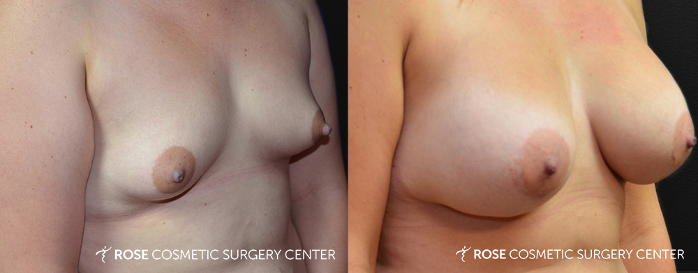 Patient 28 Breast Augmentation Before and After