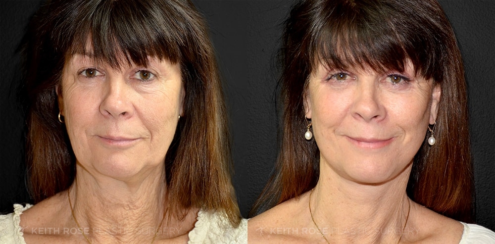 Facelift Before and After Patient 1