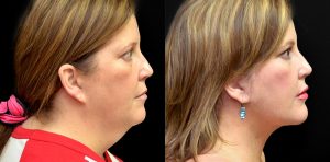 Patient 2 chin implants before and after