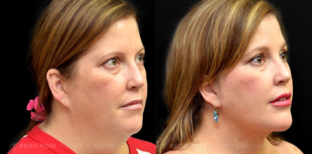 Chin Augmentation Before & After Pictures