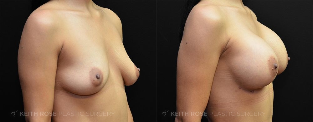 Patient 36 Breast Augmentation Before and After