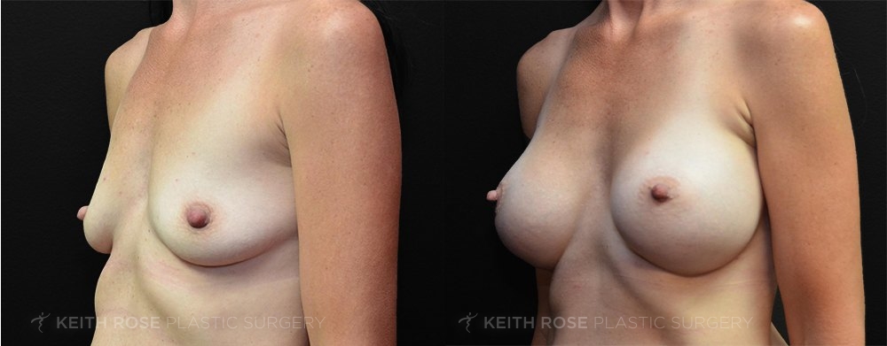 Patient 39 Breast Augmentation Before and After