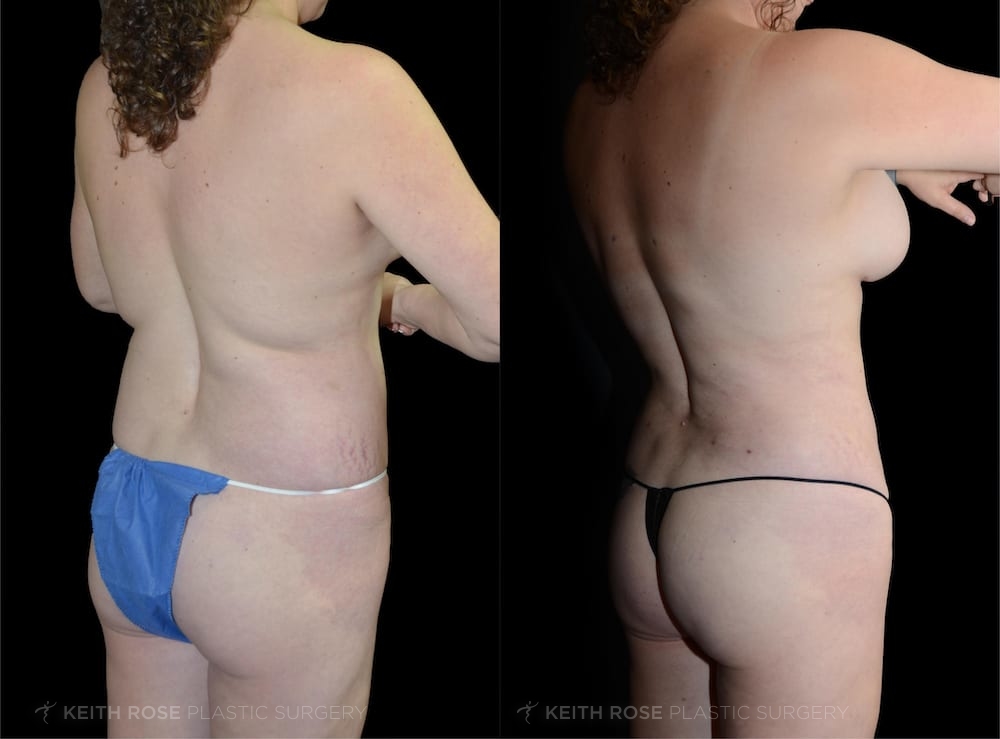 0000_rose_liposuction_corpuschristi_patient26a