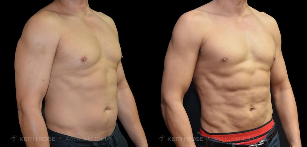 0011_rose_vaserliposuction_corpuschristi_patient32b