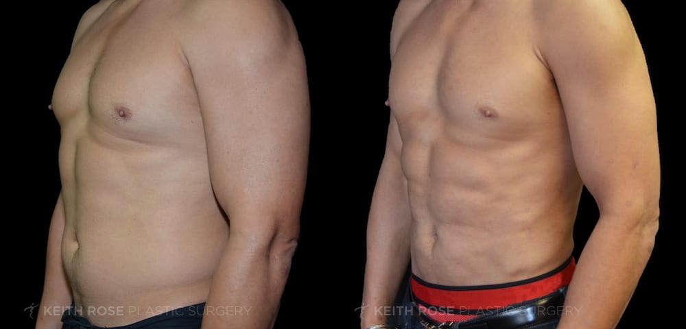 0012_rose_vaserliposuction_corpuschristi_patient32c