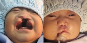 Patient 6 cleft lip before and after   j Keith rose md