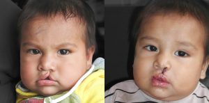 Patient 9 cleft lip before and after