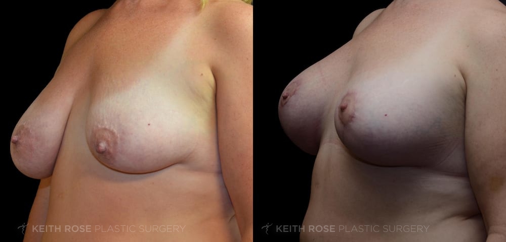 0001_rose_breastlift_corpuschristi_patient18b