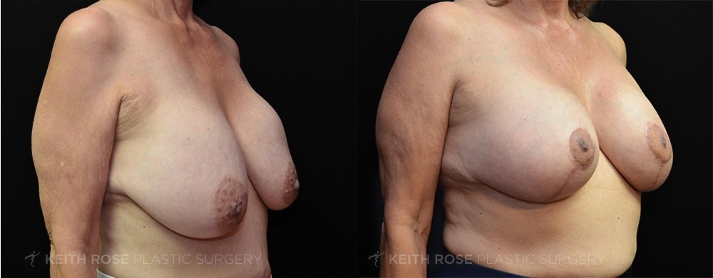 Patient 6 Breast Lift Before and After