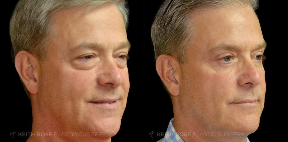 Patient 2 Blepharoplasty Before and After