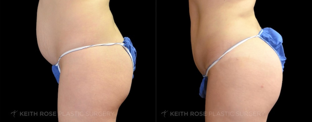 Brazilian Butt Lift Before and After