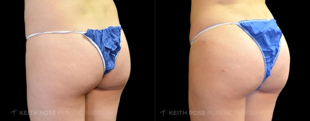 Patient 3 Brazilian Butt Lift Before and After