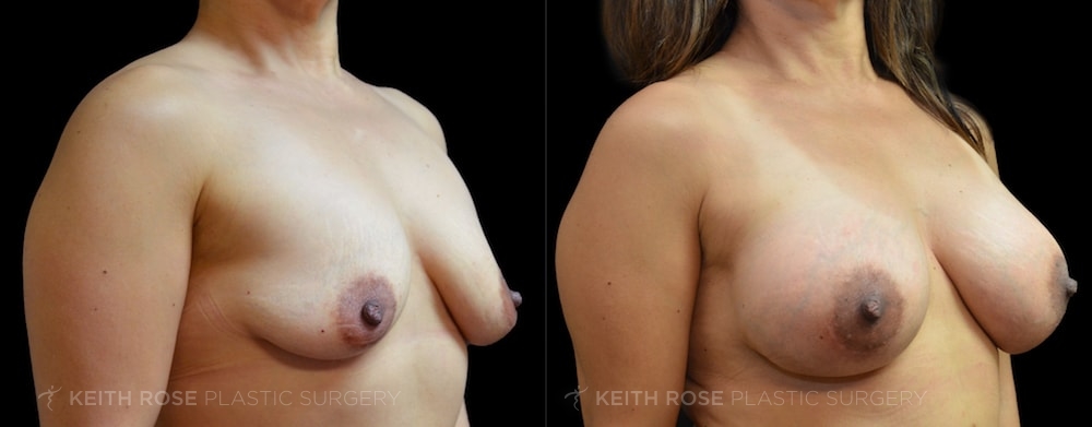 Patient 17 Breast Augmentation Before and After
