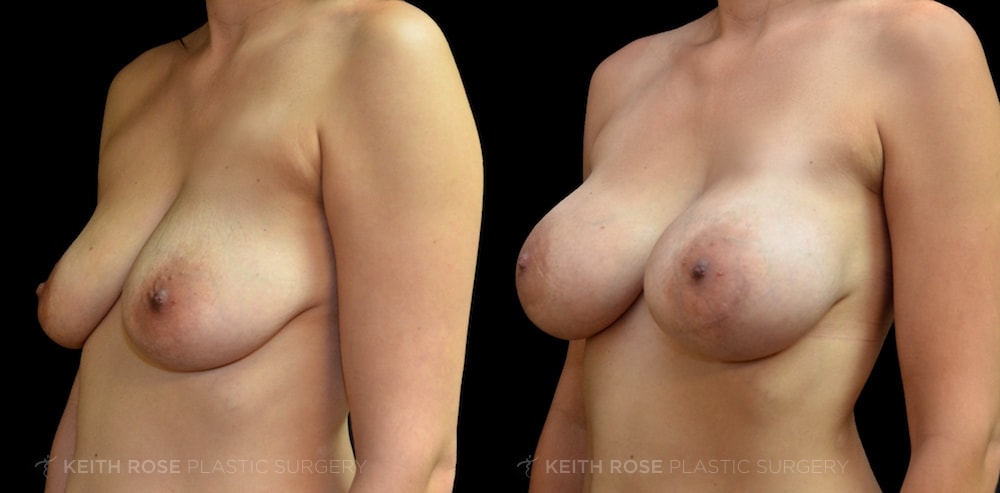 Patient 19 Breast Augmentation Before and After