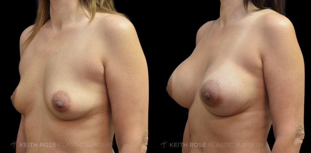 Patient 23 Breast Augmentation Before and After