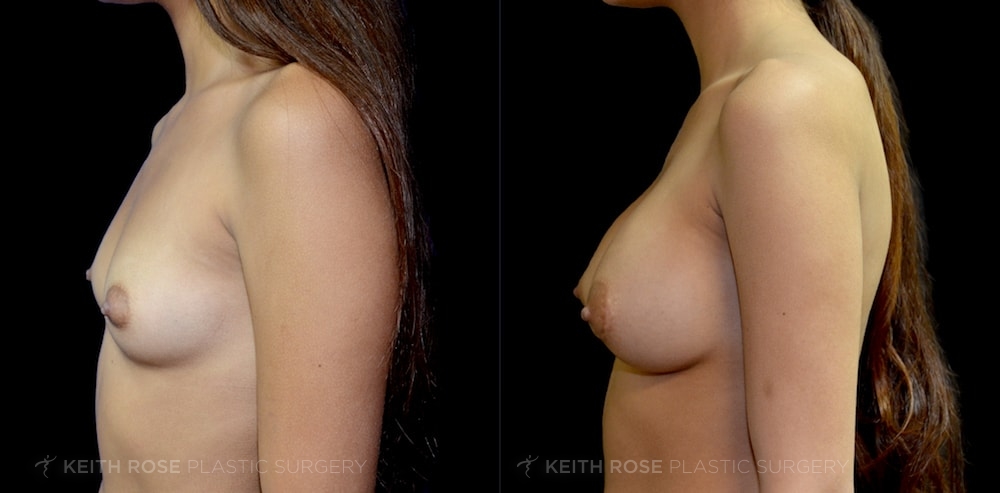 Patient 8 Breast Augmentation Before and After