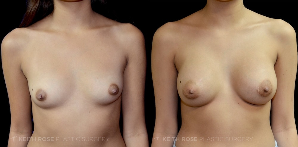 Patient 9 Breast Augmentation Before and After
