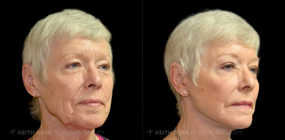 Patient 8 Facelift Before and After