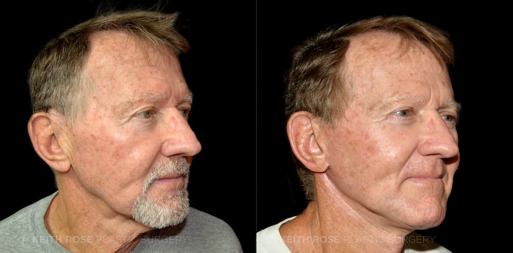 Patient 11 Facelift Before and After