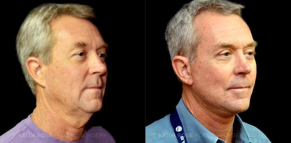 Patient 3 Facelift Before and After