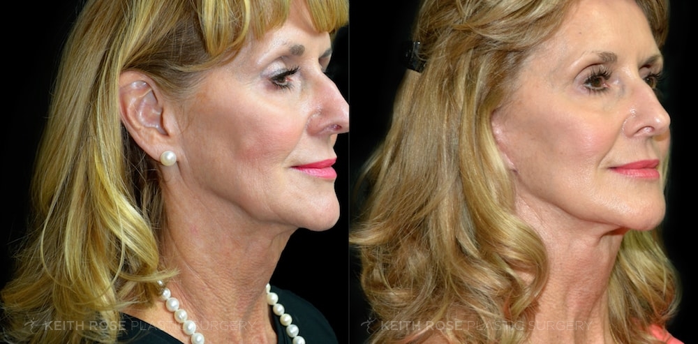 Patient 4 Facelift Before and After