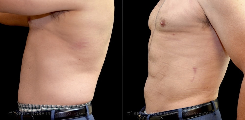 Patient 2 Liposuction Before and After