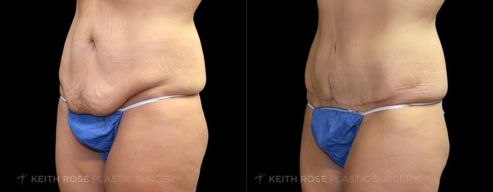 Patient 13 Tummy Tuck Before and After