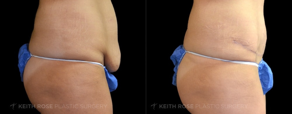 Patient 14 Tummy Tuck Before and After