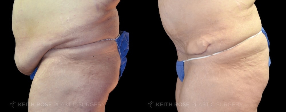 Patient 16 Tummy Tuck Before and After