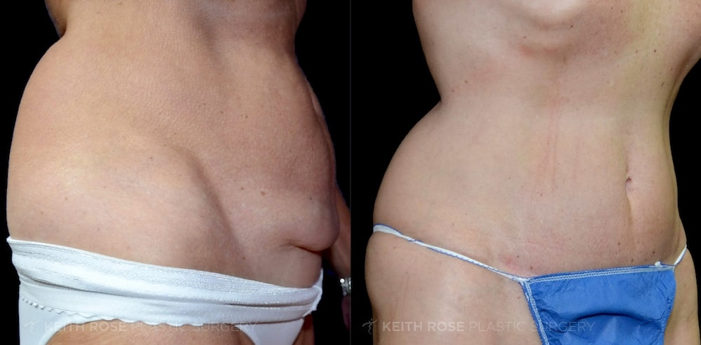 Patient 5 Tummy Tuck Before and After