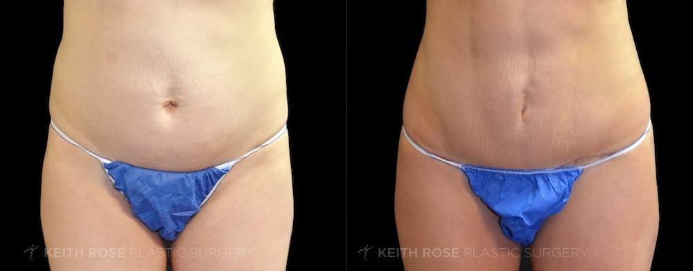 Patient 2 Tummy Tuck Before and After