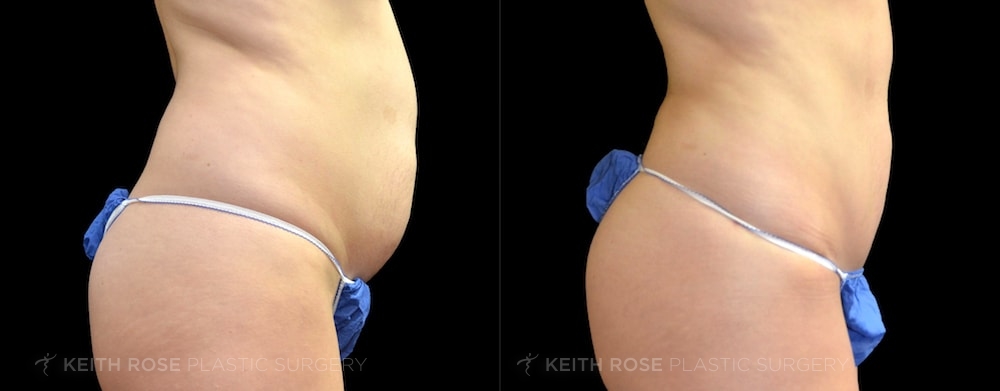 Patient 3 Tummy Tuck Before and After