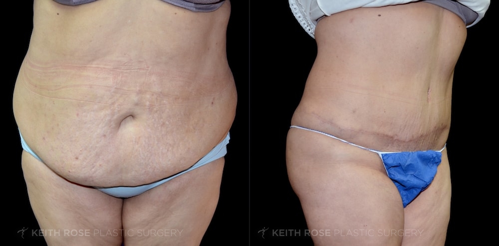 Patient 8 Tummy Tuck Before and After