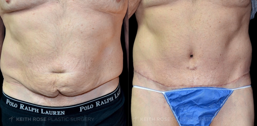 Patient 10 Tummy Tuck Before and After