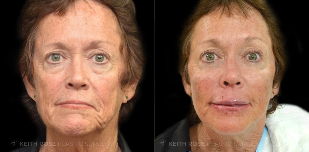 Patient 1 Dermal Fillers Before and After