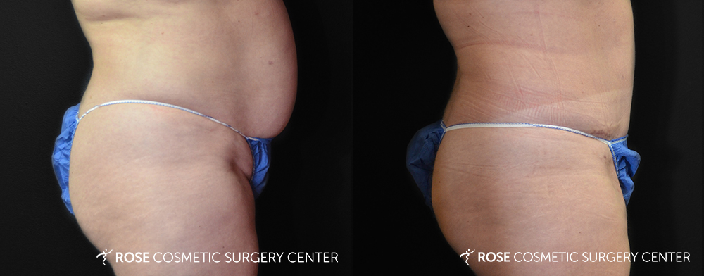 Patient 18 Tummy Tuck Before and After