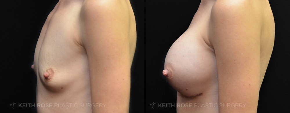 Patient 30 Breast Augmentation Before and After