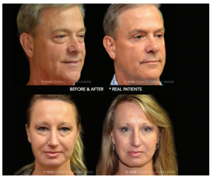 Surgical treatment of aging eyelids