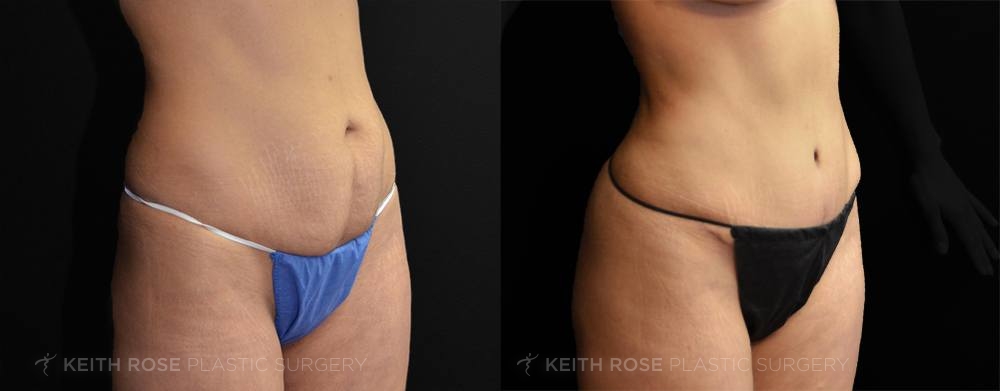 Patient 20 Tummy Tuck Before and After