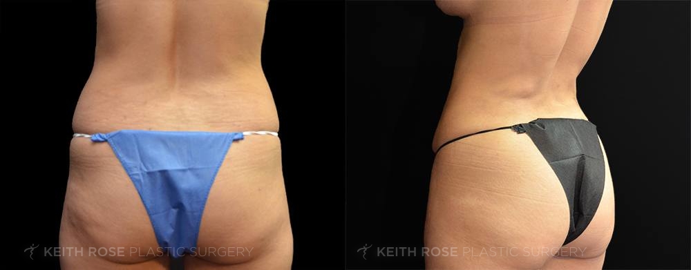 Patient 21 Tummy Tuck Before and After