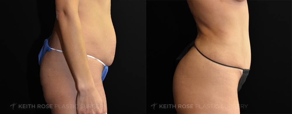 Before and After Tummy Tuck