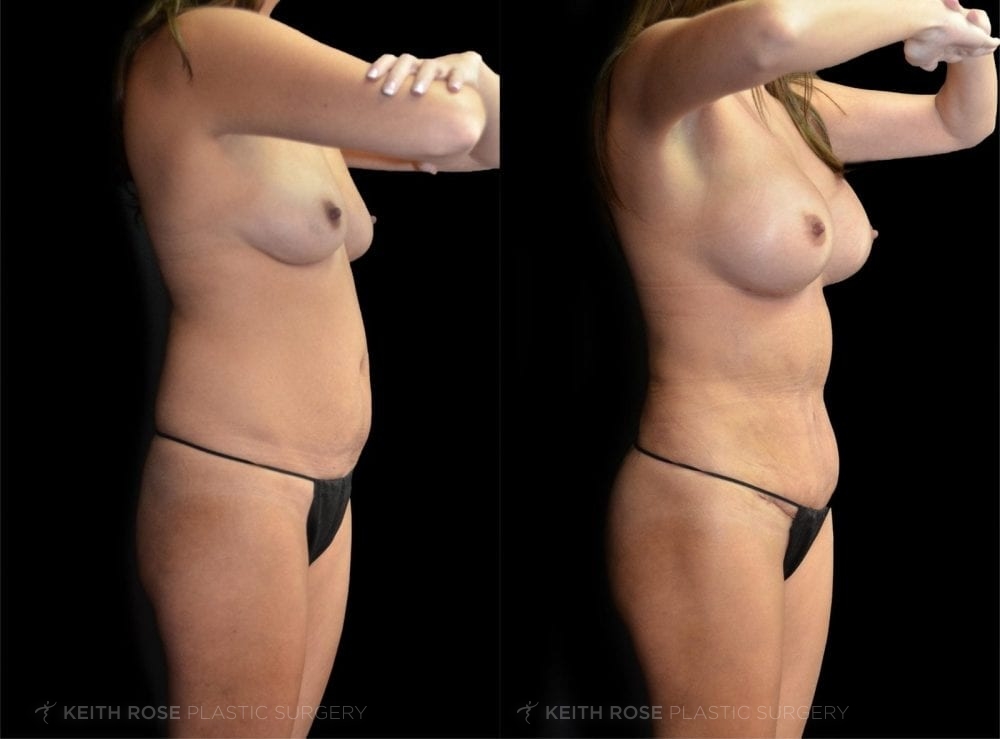 0000_rose_mommymakeover_corpuschristi_patient60a